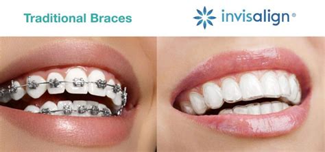 invisible braces metal brackets|best invisible braces for overbite.